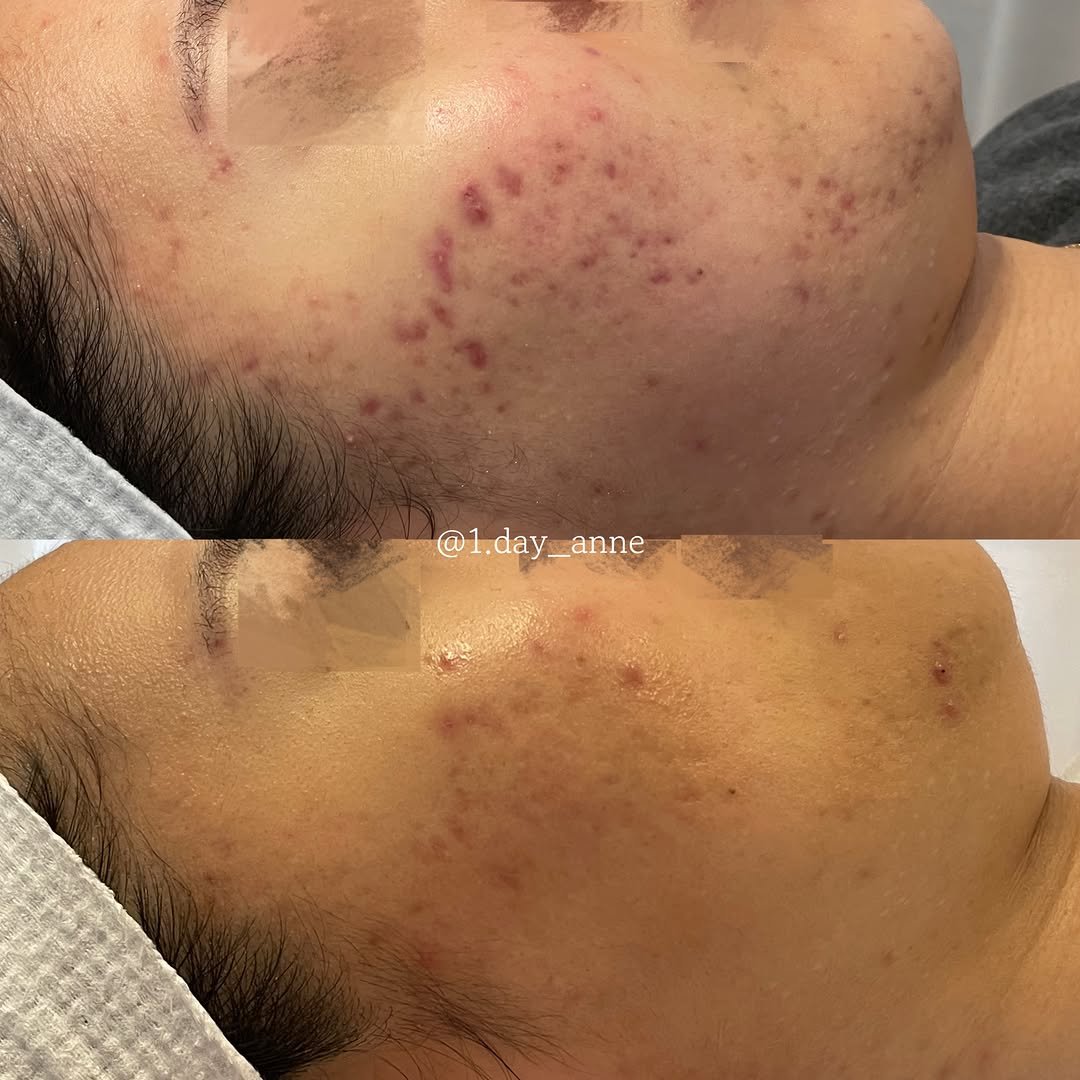 1.day_anne 게시물 이미지: 사진으로는 흉터가 가장 먼저 눈에 들어오는 피부였습니다.

하지만 처음 상담하면서...