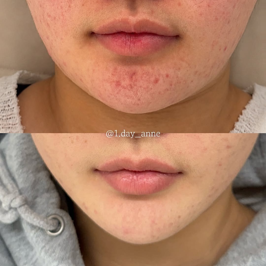 1.day_anne 게시물 이미지: 색소 때문에 레이저만 계속 받고 계신가요?🤔

피부가 예민하고 회복력이 떨어진...