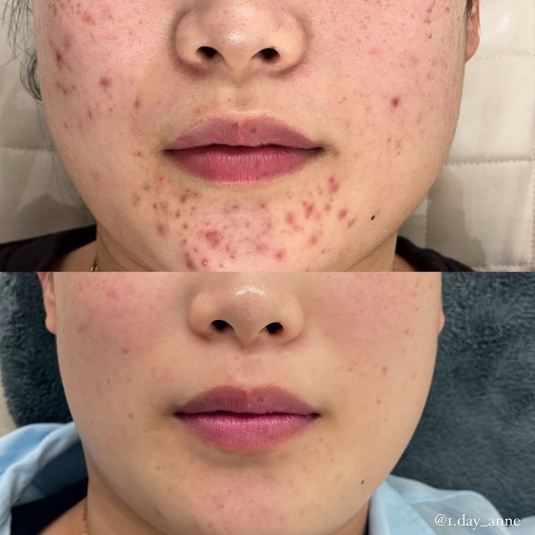 1.day_anne 게시물 이미지: 색소 침착은
단순히 밝히는 관리만으로는 잘 정리되지 않아요.

염증 후에 남은...