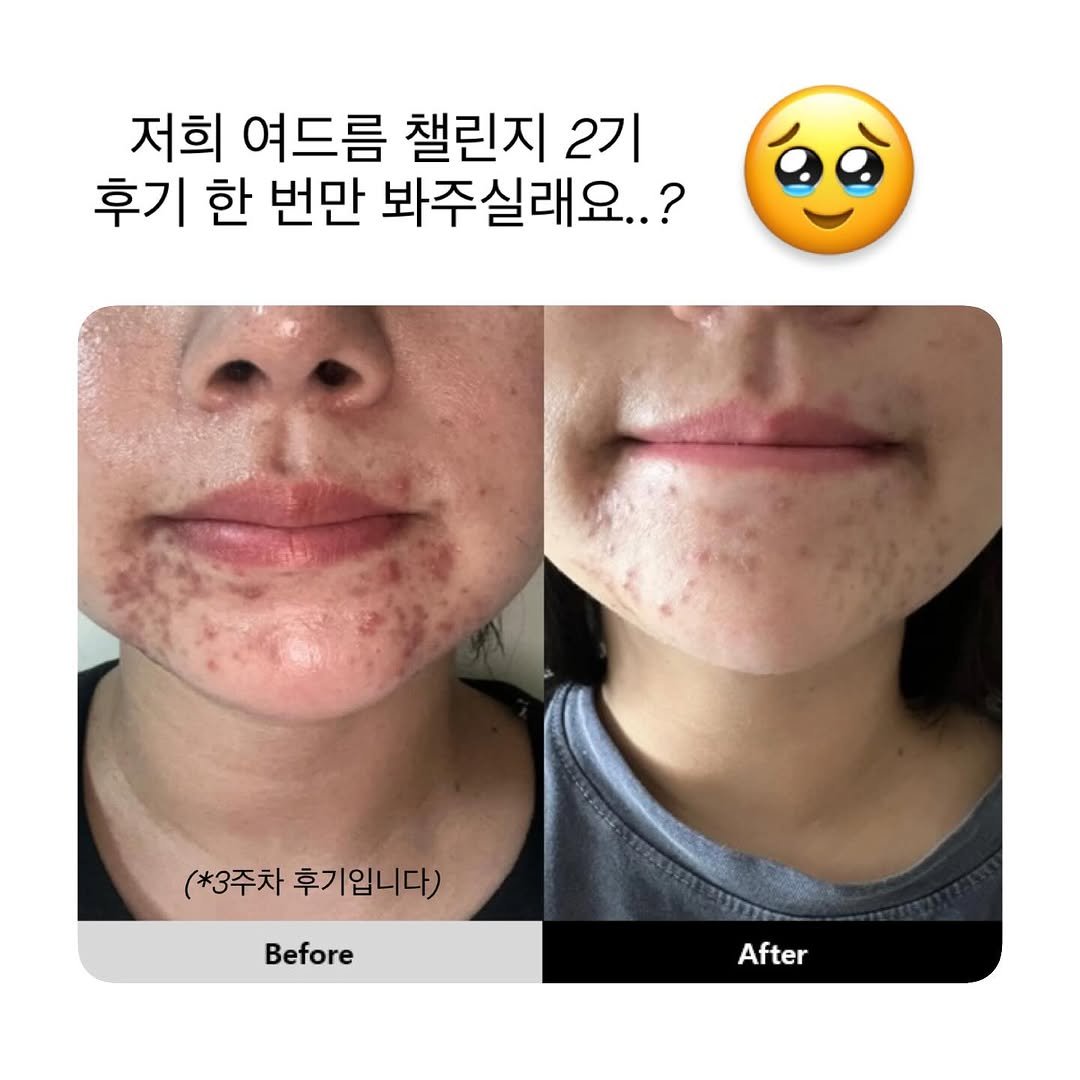 Photo by 모리녀 | 모든 걸 리뷰하는 여자 on August 11, 2025. May be an image of 2 people and text that says '저희 여드름 챌린지 2기 후기 한 번만 봐주실래요..? (*3주차후기입니다) (*3주차 후기입니다) Before Before After'.